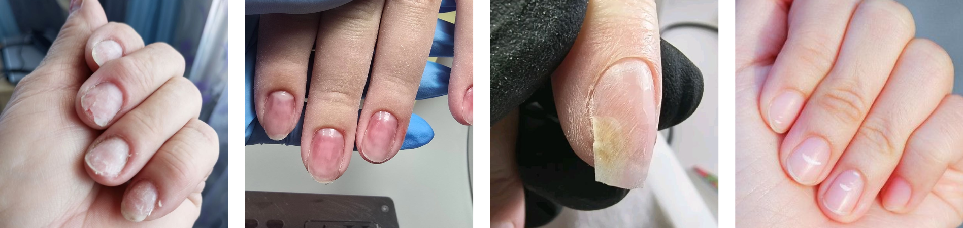 Anzeichen geschwächter Nägel